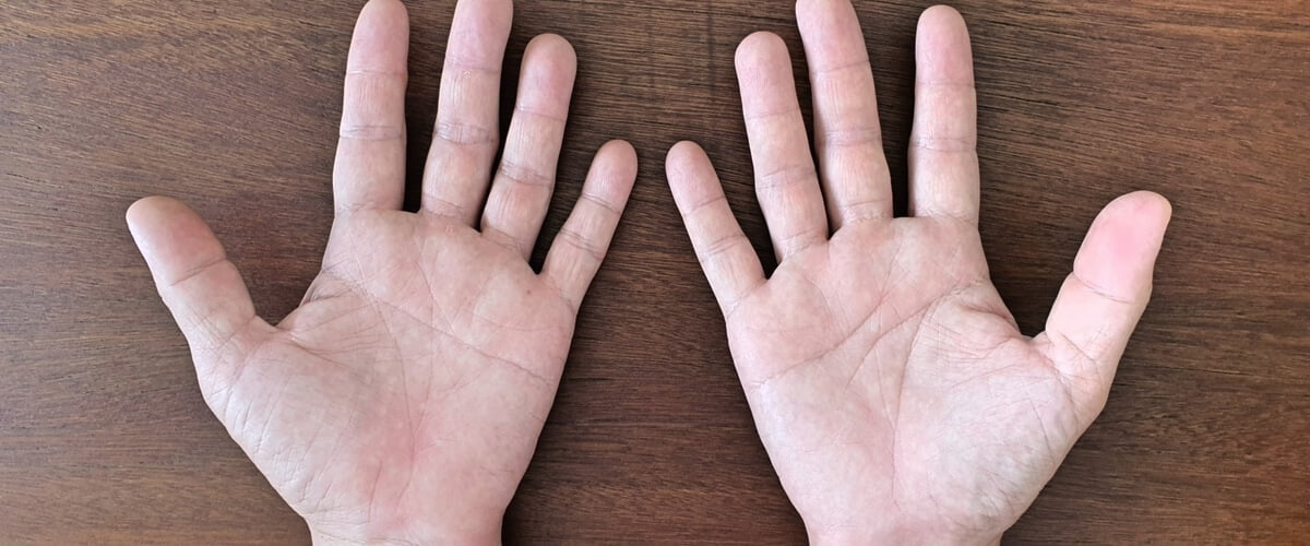 Dr Andy Teh's hands, which are affected by bilateral carpal tunnel syndrome
